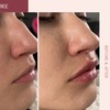 Image 5: Rejuvenate Your Look with 20, 40, or 60 Units of Botox