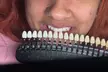 1 or 3 Teeth Whitening Sessions (30 or 45 Min) for a Dazzling Smile at Janiyah Gilliam Up To  48% Off - Second Medium
