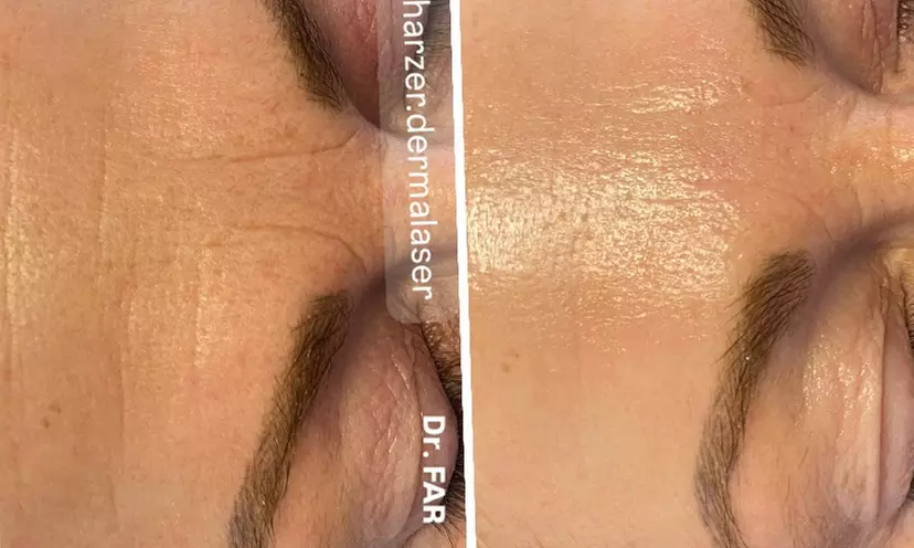 Enzym-Hauterneuerung & Serum-Therapie, optional mit Microneedling