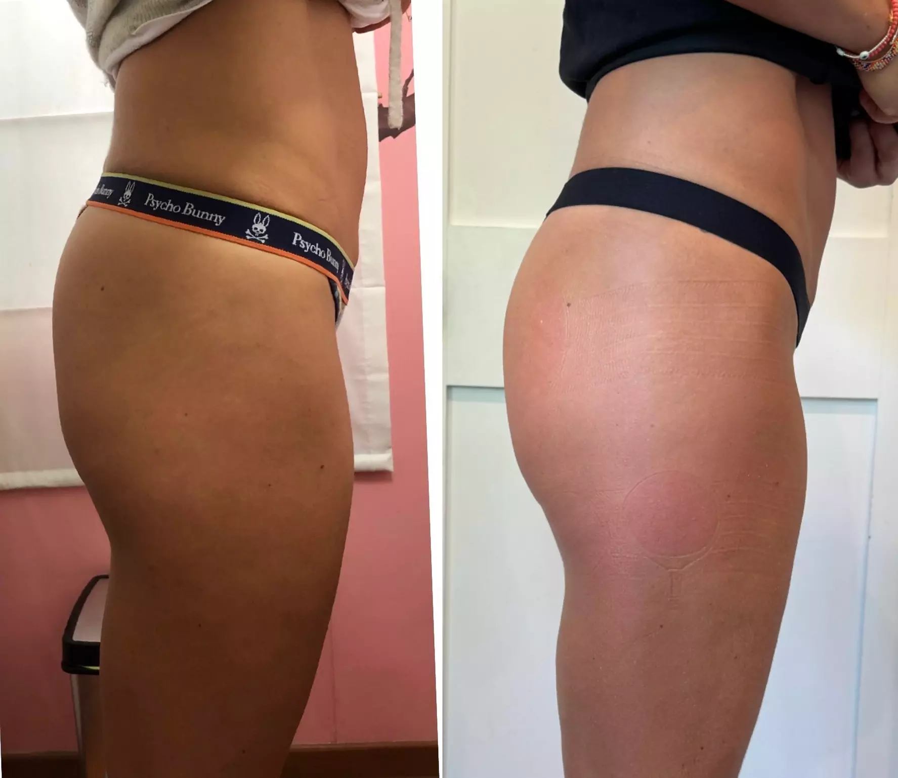 Zap Your Way to Fitness: Unleash the Power of EMS Today!