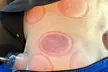Up to 30% Off on Cupping at Navigate Health Chiropractic - Second Medium