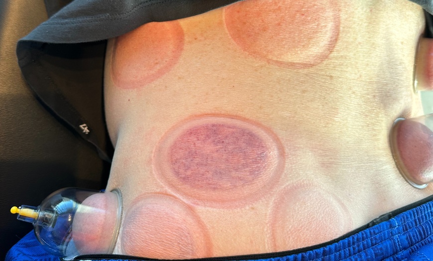 Image 4: Up to 37% Off on Cupping at Navigate Health Chiropractic