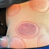 Image 4: Up to 37% Off on Cupping at Navigate Health Chiropractic