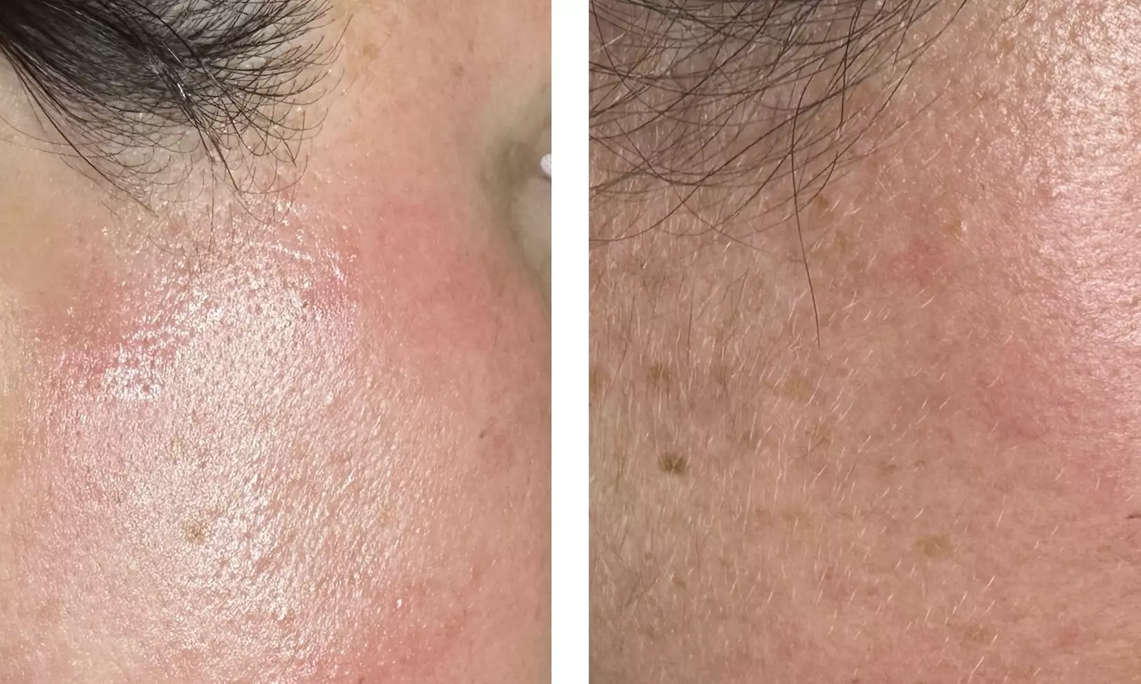 Up to 25% Off on Facial - Oxygen at Brilliance Beauty Boutique - Primary Image