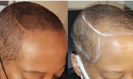 50% Towards Men and Women's Scalp Micropigmentation Treatments - Derma-Artistry Cosmetic Tattooing