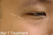 Up to 71% Off on Vampire Facelift at One Beauty Aesthetics - Second Medium