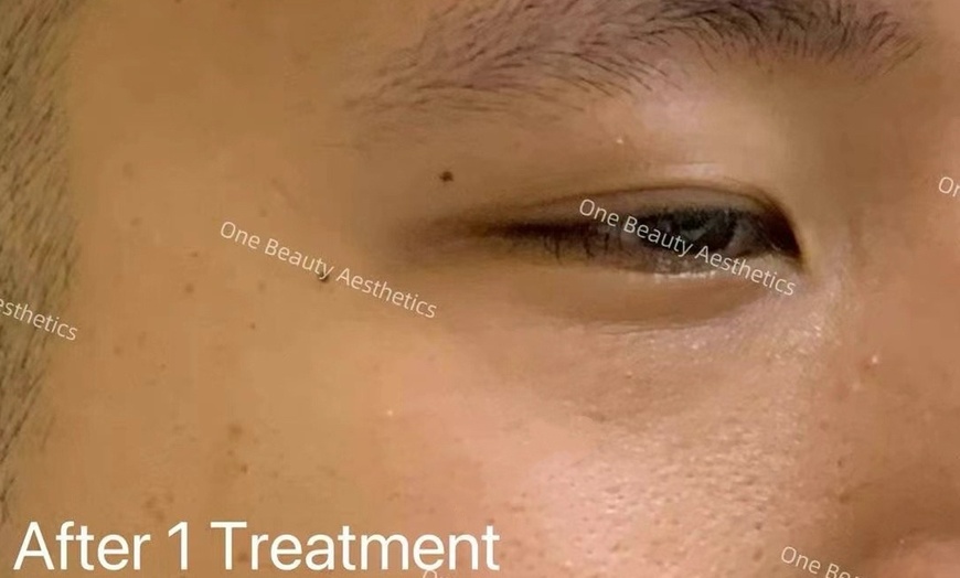 Image 2: Up to 71% Off on Vampire Facelift at One Beauty Aesthetics