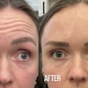 Image 1: Up to 65% Off on Injection - Botox at Nude Aesthetics