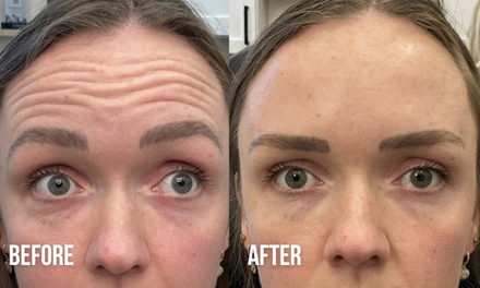 20 Units of Botox - Nude Aesthetics