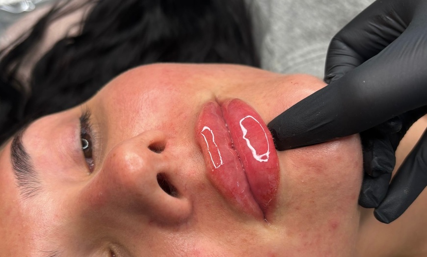 Image 1: Up to 54% Off on Injection - Dermal Filler at Perfection Clinic