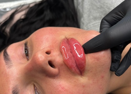 0.5ml - Precision Filler with Comprehensive Aesthetic Consultation - Perfection Clinic