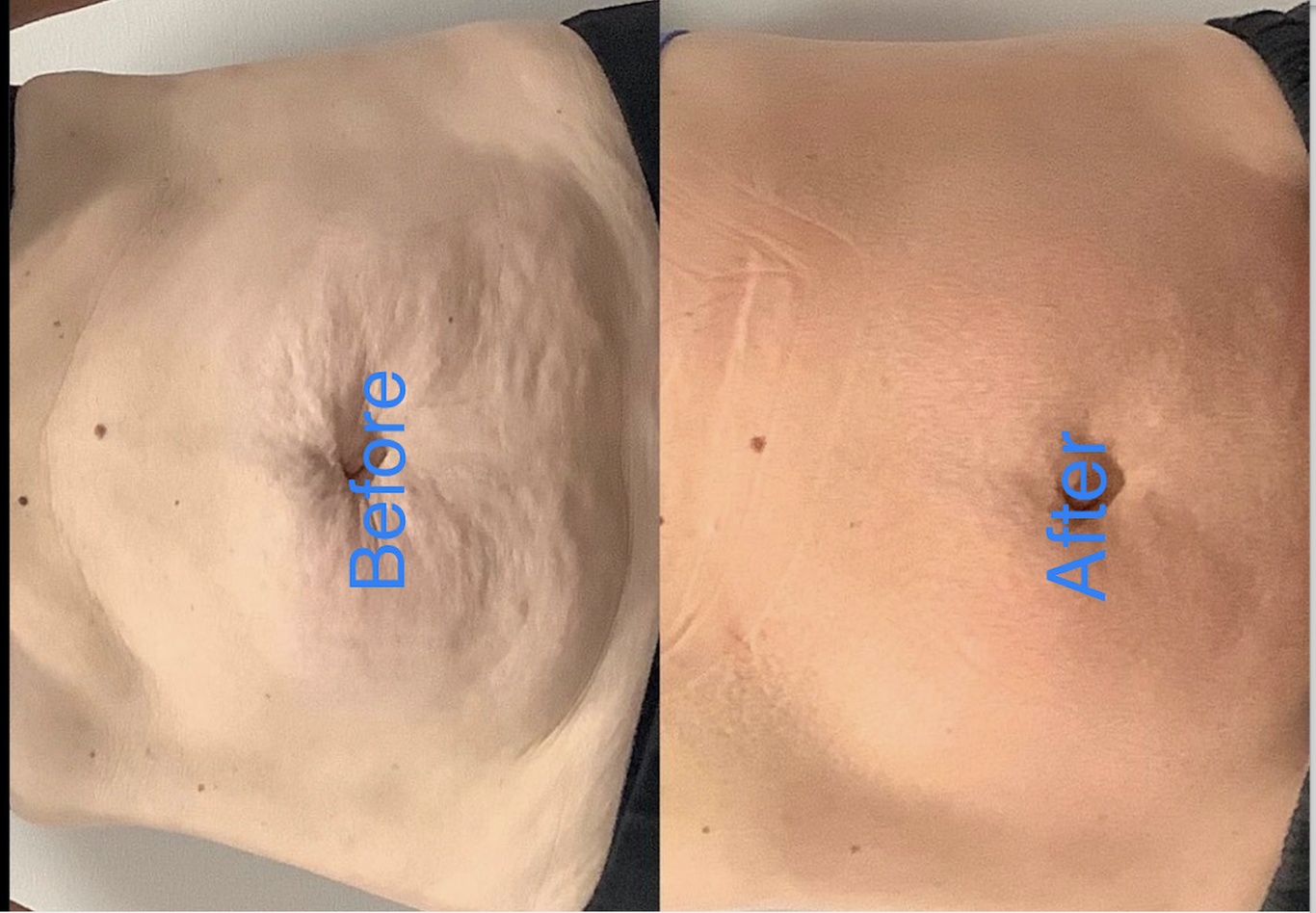 Up to 84% Off on Lipo - Non-Invasive Laser-iLipo at Scuplted Curves