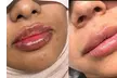 Up to 61% Off on Injection - Dermal Filler at Skin Treat Aesthetics - Second Medium