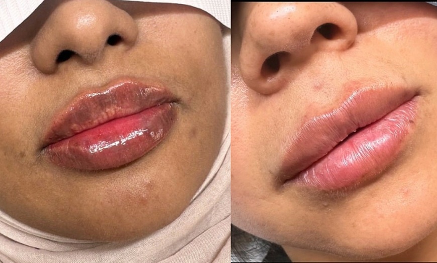 Image 2: Up to 61% Off on Injection - Dermal Filler at Skin Treat Aesthetics