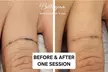 Bellagena Offers Three Laser Tattoo Removal Sessions for Small, X-Small, or XX-Small Areas (Up to 56% Off) - Second Medium