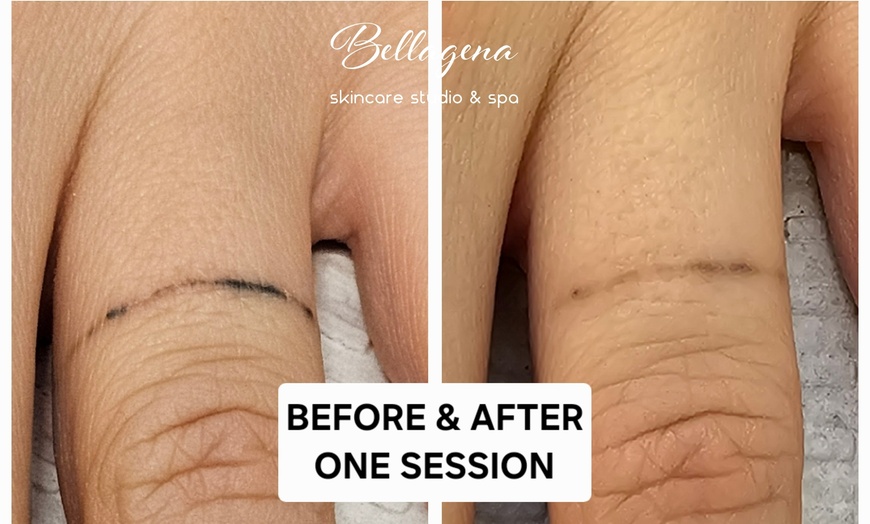 Image 2: Bellagena Offers Three Laser Tattoo Removal Sessions for Small, X-Small, or XX-Small Areas (Up to 56% Off)