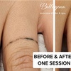 Image 2: Bellagena Offers Three Laser Tattoo Removal Sessions for Small, X-Small, or XX-Small Areas (Up to 56% Off)