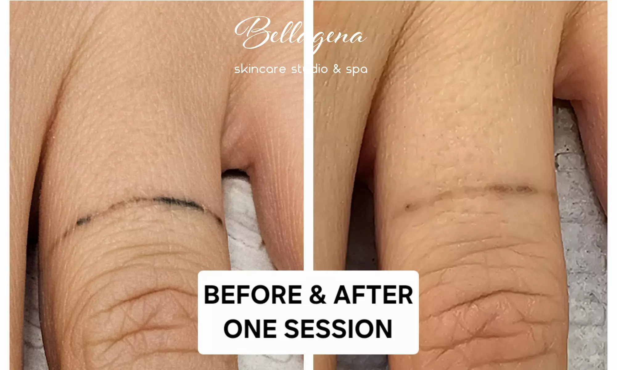 Bellagena Offers Three Laser Tattoo Removal Sessions for Small, X-Small, or XX-Small Areas (Up to 56% Off)