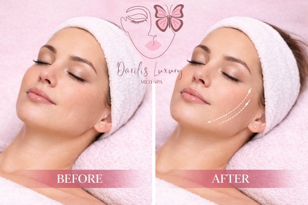 Youthful Look with PDO collagen Threads ( 6 Threads) - Darilis Luxury