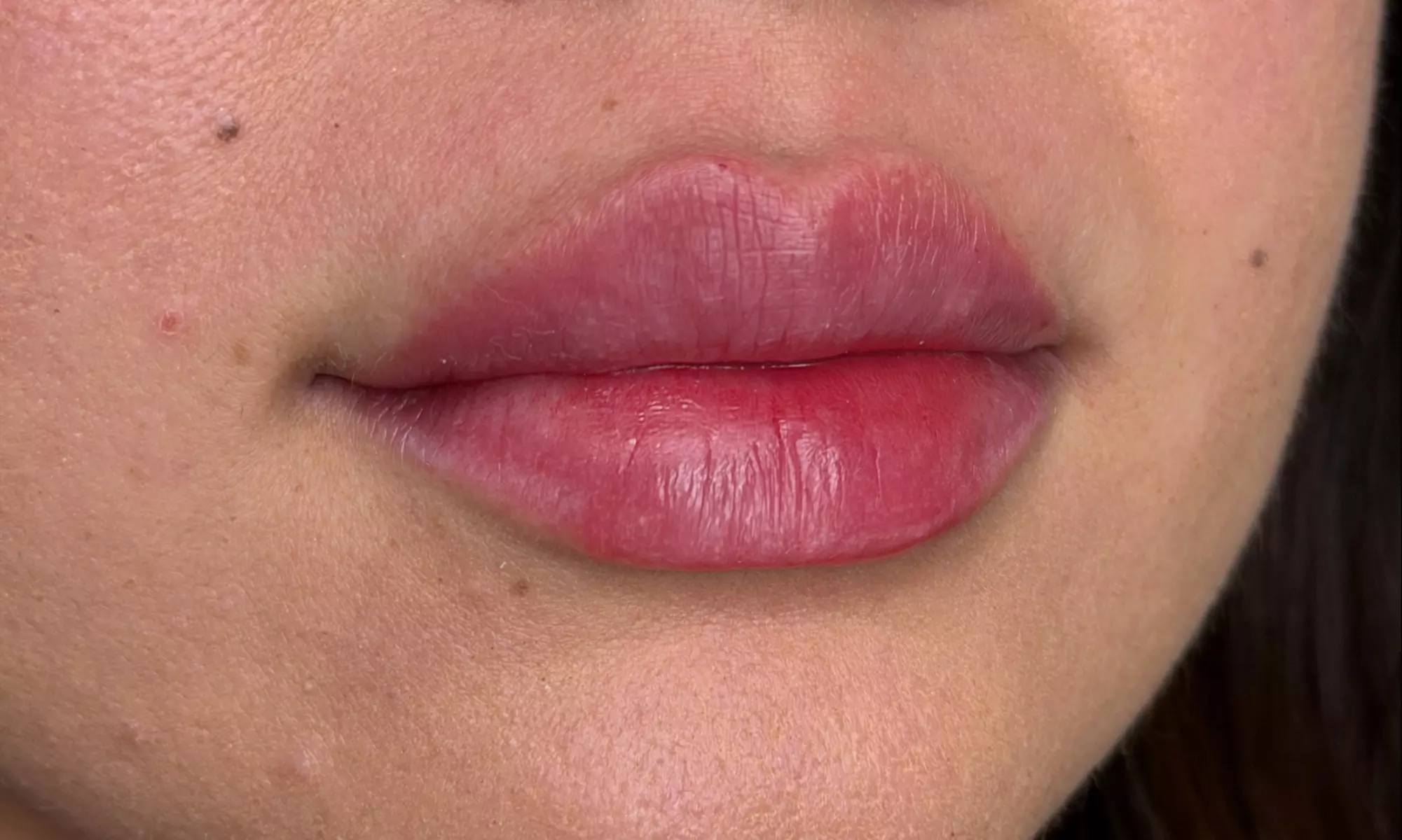 Up to 33% Off on Injection - Botox at Skinn Loft