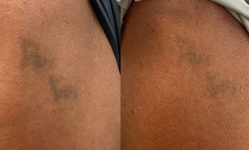 Image 5: Experience Laser By Nicole - Fort Lauderdale with three tattoo removal treatments for various area sizes up to 37% off