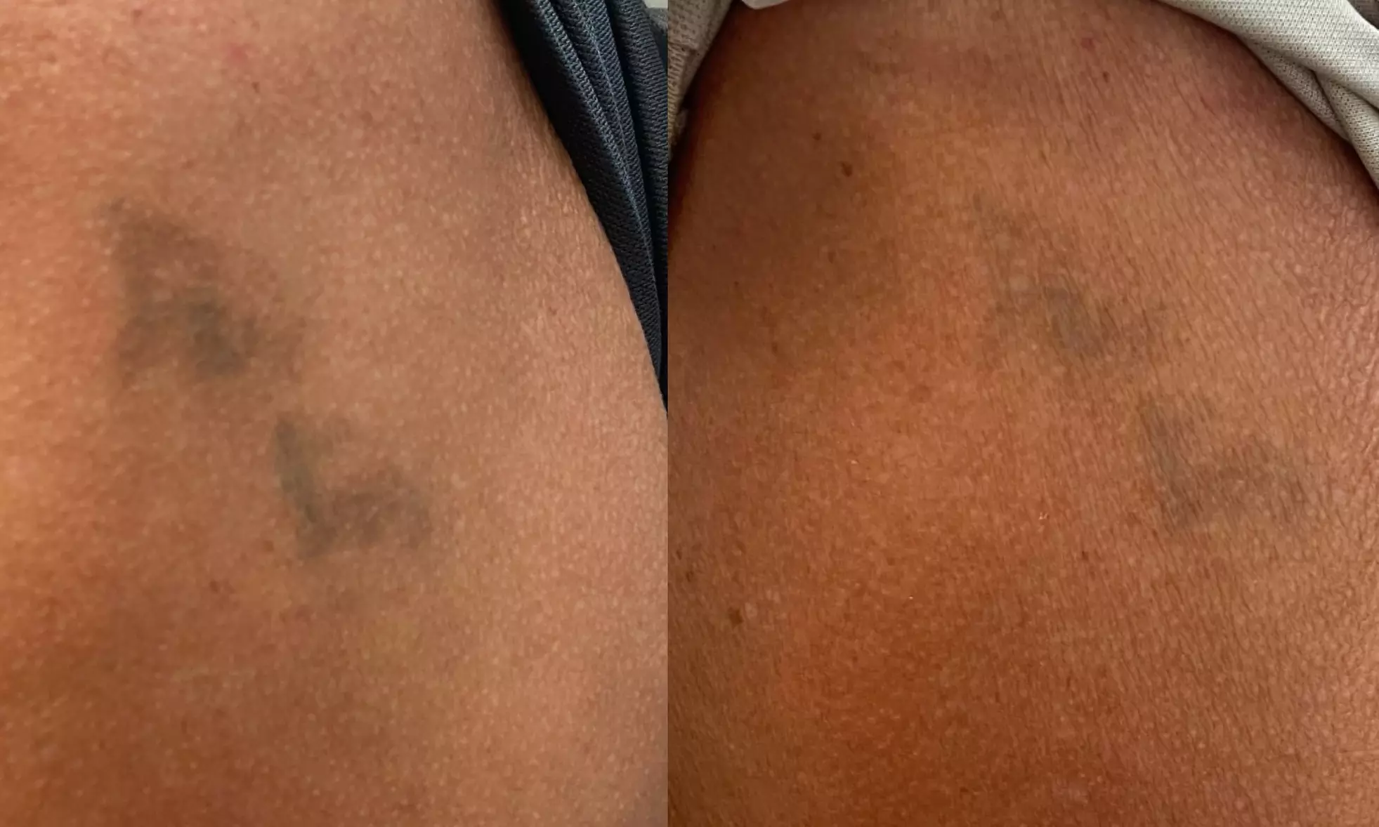 Experience Laser By Nicole - Fort Lauderdale with three tattoo removal treatments for various area sizes up to 37% off - Second Medium