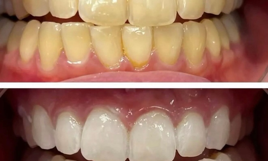 Image 3: Signature Teeth Whitening or Signature Teeth Whitening Package of 3