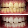 Image 3: Signature Teeth Whitening or Signature Teeth Whitening Package of 3