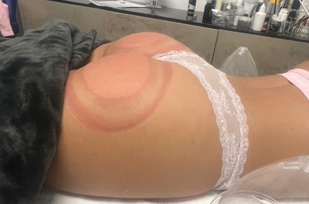 1 Popo-Lift-Vakuum-Behandlung - Gonca´s Beauty