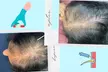 Up to 55% Off on Hair Restoration - Non-Surgical at Aesthetics Care Med Spa - Second Medium