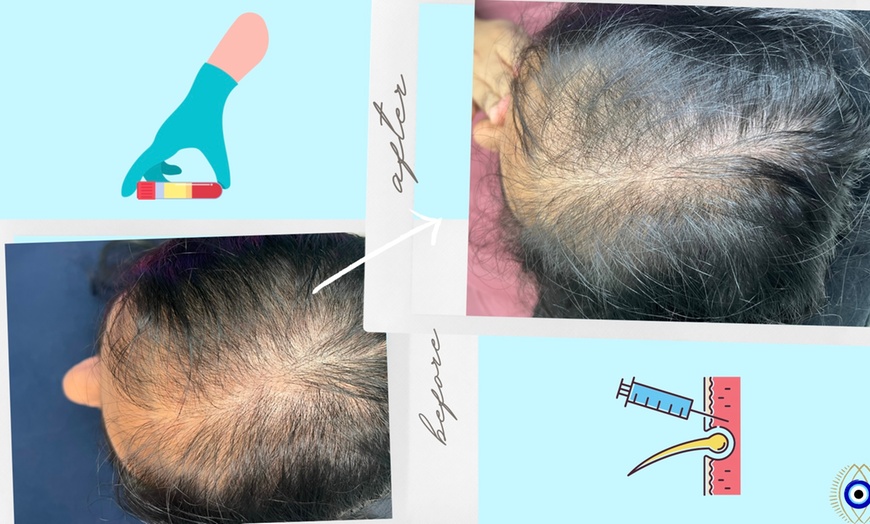 Image 2: Up to 60% Off on Hair Restoration - Non-Surgical at Aesthetics Care Med Spa