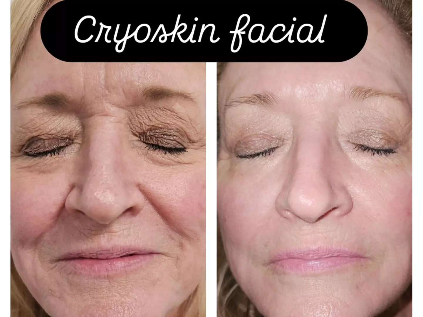 One or Three 45 Min Cryo Facial or Toning Treatment or Combo of Both