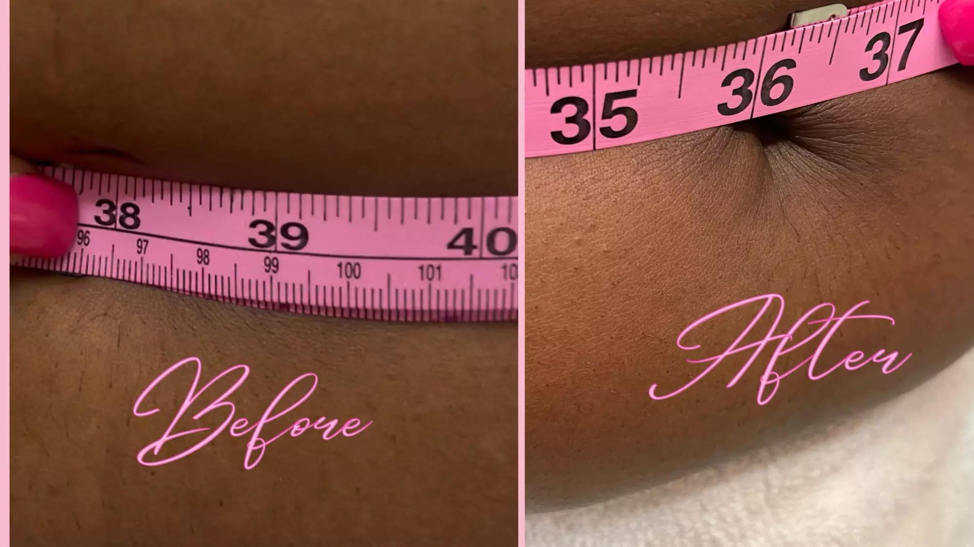 Shape & Tone Your Body with Cavitation and Vacuum Therapy Sessions