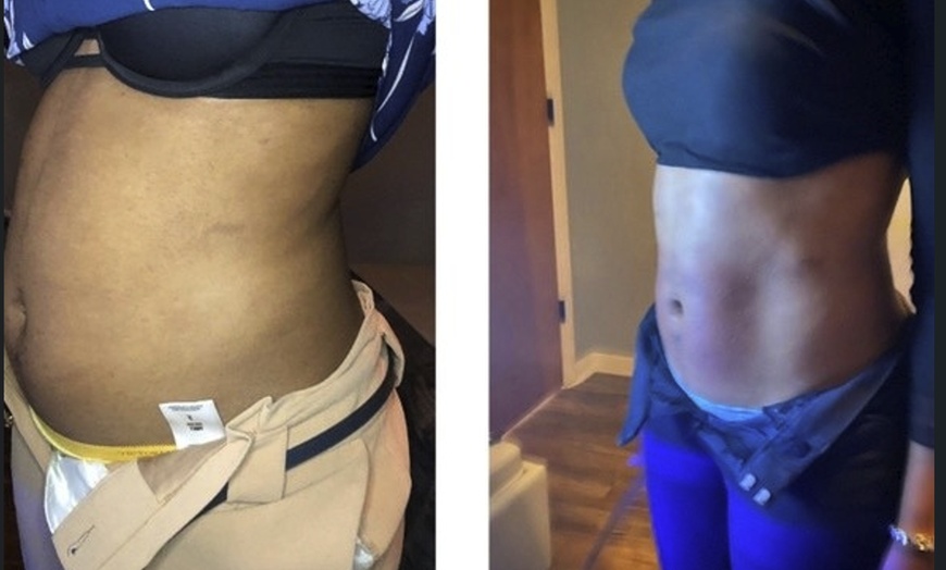 Image 4: Single Session of BodyFX or MiniFX Fat Reduction and Skin Tightening