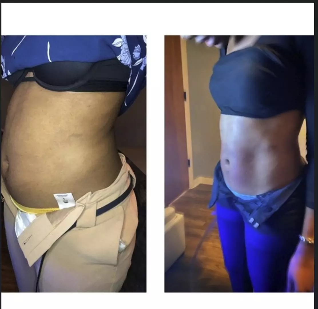 Single Session of BodyFX or MiniFX Fat Reduction and Skin Tightening
