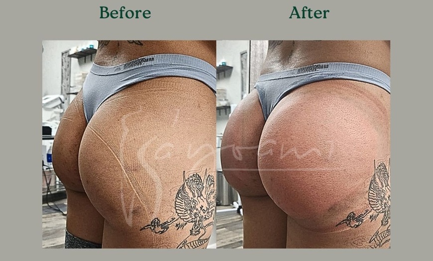 Image 4: Vacuum Therapy Buttocks & Body Enhancement or CryoStatic Slimming