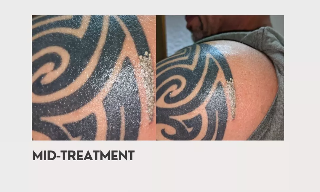 Up to 53% Off on Tattoo Removal at Urban Skin Loft | Laser & Aesthetics - Second Medium