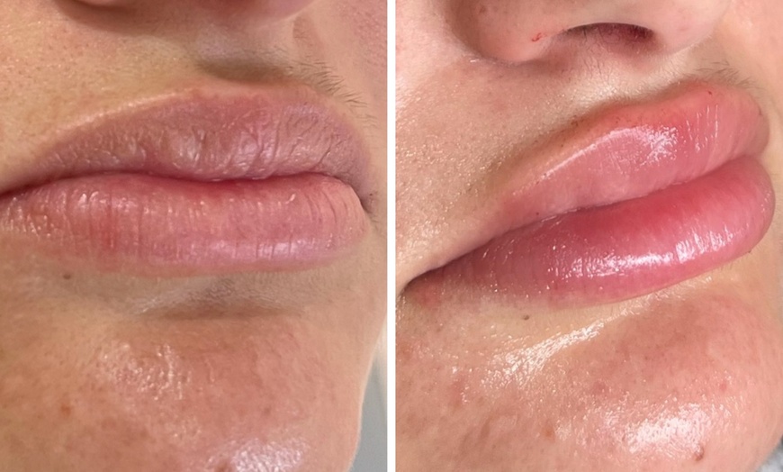 Image 4: Up to 63% Off on Injection - Dermal Filler at The Nordic Skin Clinic