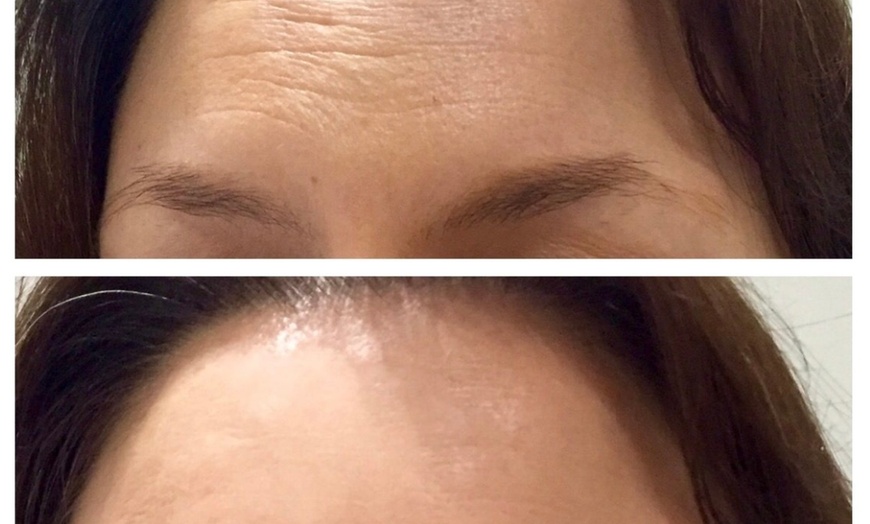 Image 8: 3 o 6 sesiones de lipoláser, radiofrecuencia y presoterapia