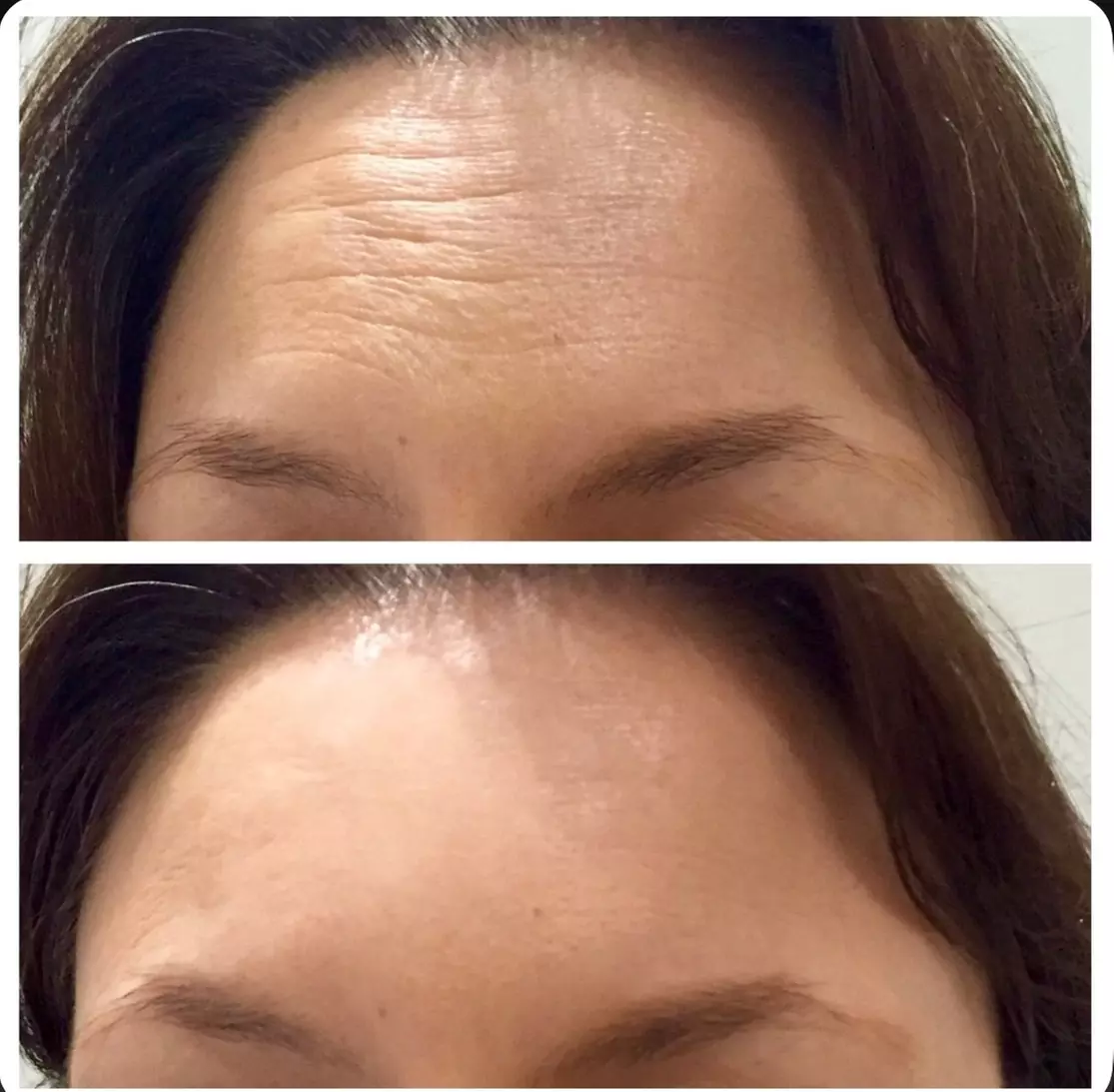 3 o 6 sesiones de lipoláser, radiofrecuencia y presoterapia