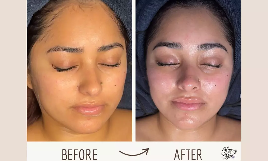 Glow Up with One or Two Custom Facials OR Dermaplaning Treatments