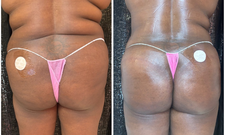 Image 7: Lift and tone with nonsurgical butt cupping sessions