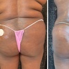 Image 7: Lift and tone with nonsurgical butt cupping sessions