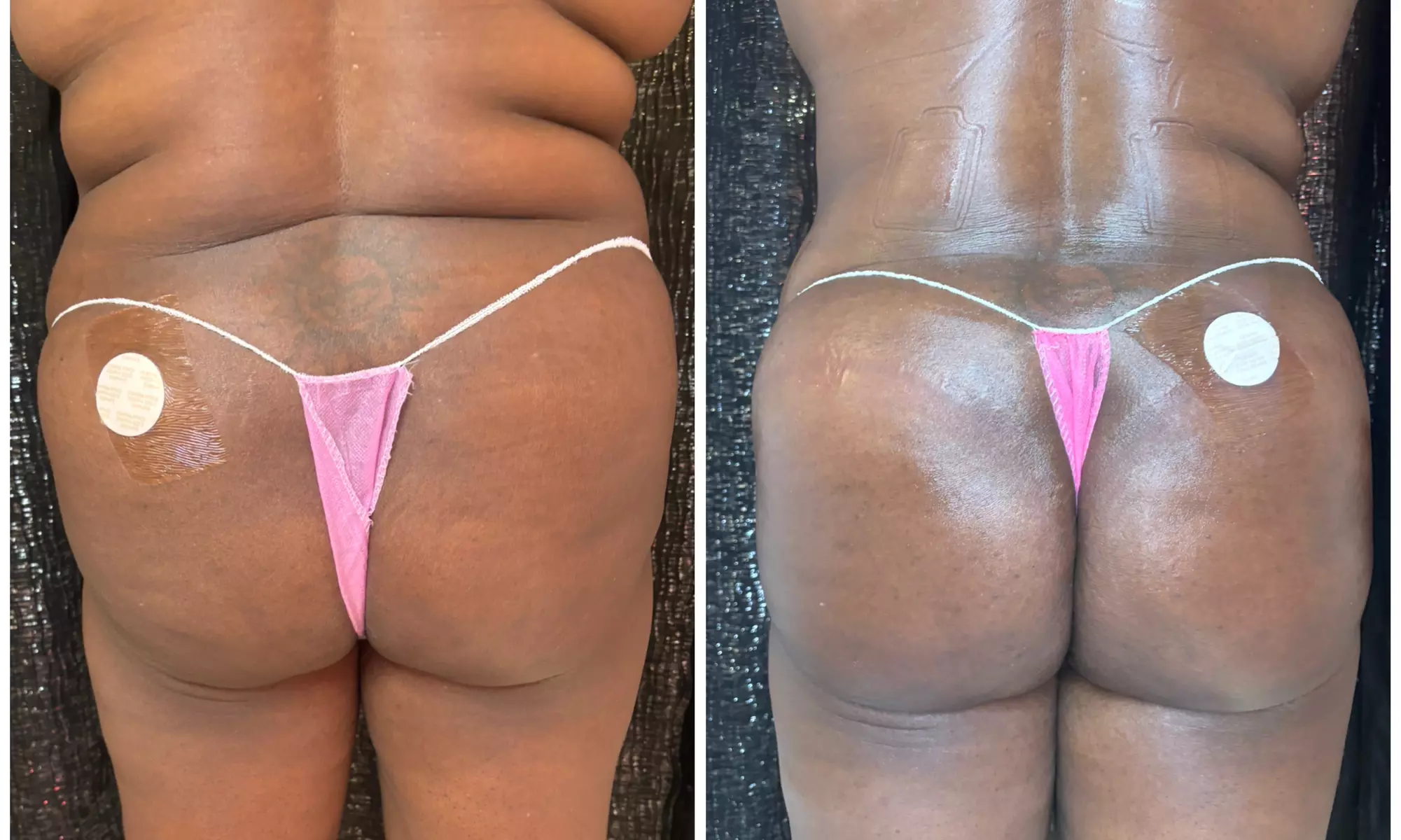 Lift and tone with nonsurgical butt cupping sessions
