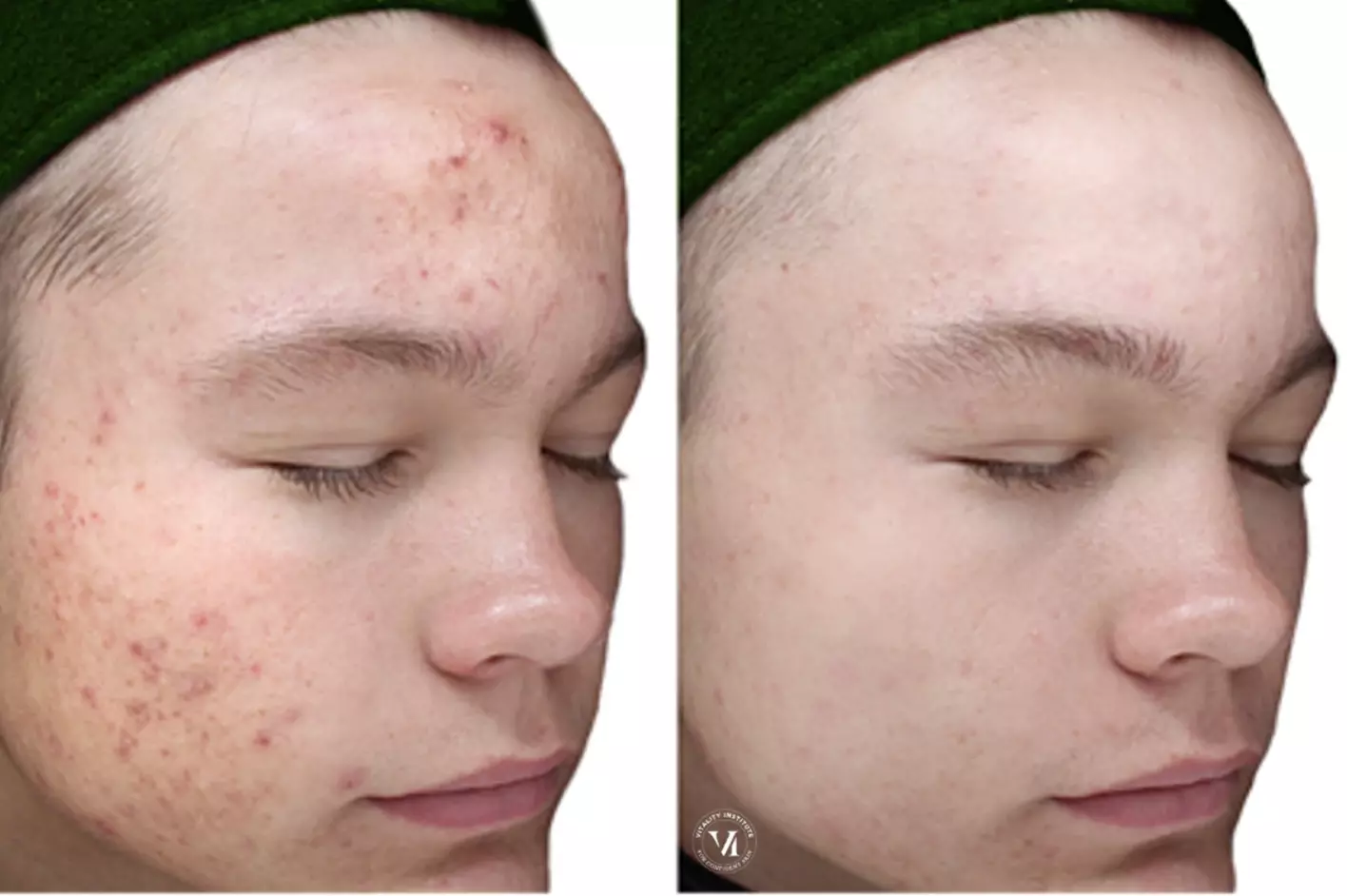 Get a Clearer Skin with One or Two VI Peel Purify Acne/Glow Treatments at Total Body Aesthetics (Up to 53% Off) - Second Medium