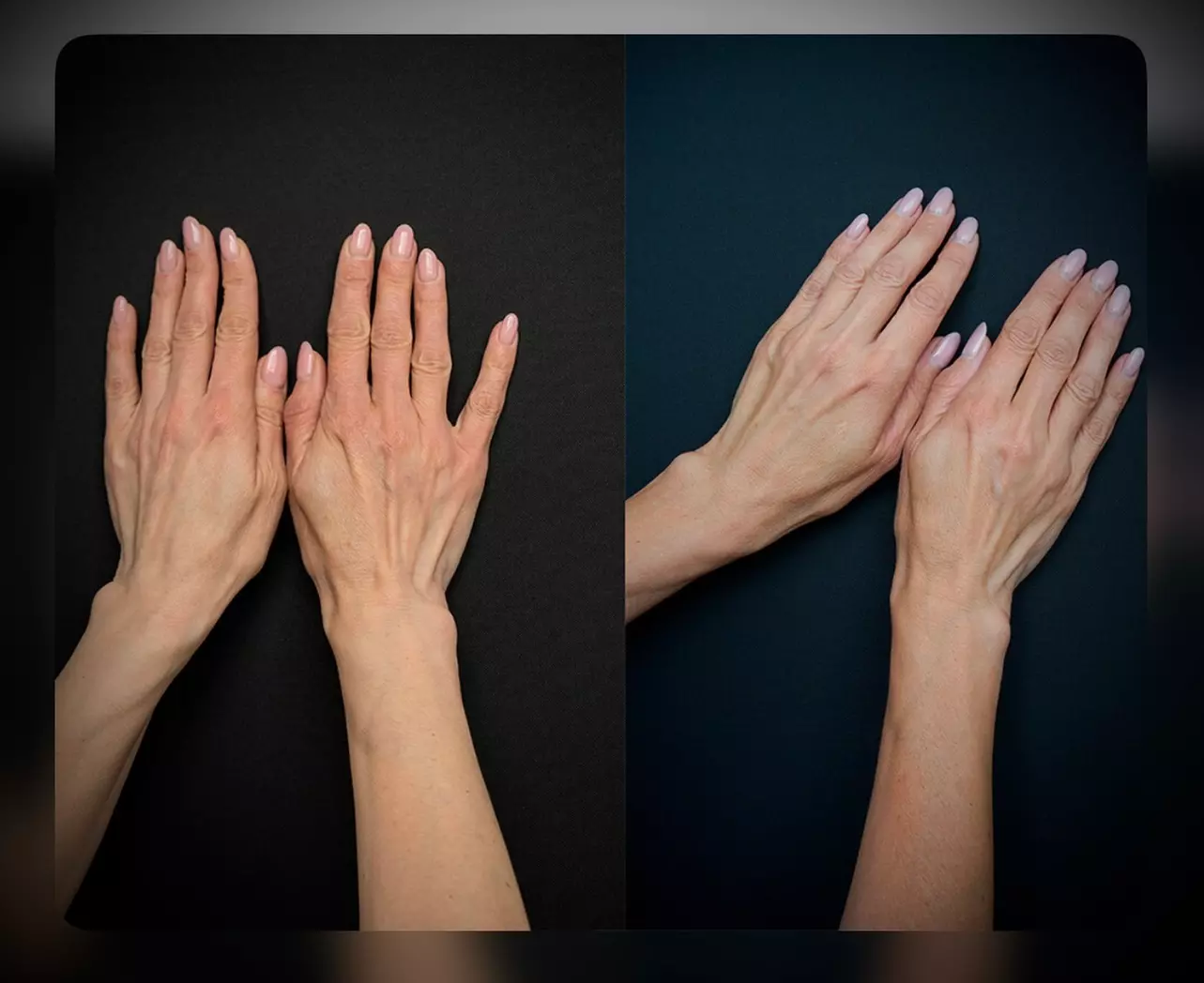 Odmładzająca pielęgnacja: RF lifting dłoni w Tatuaż & Beauty “Sorry Mom” (do -43%) - Primary Image