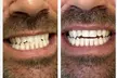 Up to 79% Off on Teeth Whitening at B and K Smile Bright Studios - Second Medium