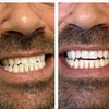 Image 2: Up to 79% Off on Teeth Whitening at B and K Smile Bright Studios