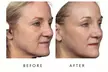 Face-Slim – Non-Invasive Facial Fat Reduction & Contouring at Your Sculpt Studio in Washington, DC - Second Medium