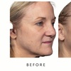 Image 4: Face-Slim – Non-Invasive Facial Fat Reduction at Your Sculpt Studio DC